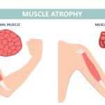 10 Tips Mengurangi Risiko Atrofi Otot dengan Gaya Hidup Aktif