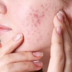 5 Cara Bagaimana Stres Memengaruhi Acne dan Cara Mengatasinya