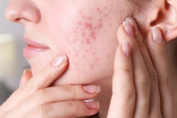5 Cara Bagaimana Stres Memengaruhi Acne dan Cara Mengatasinya