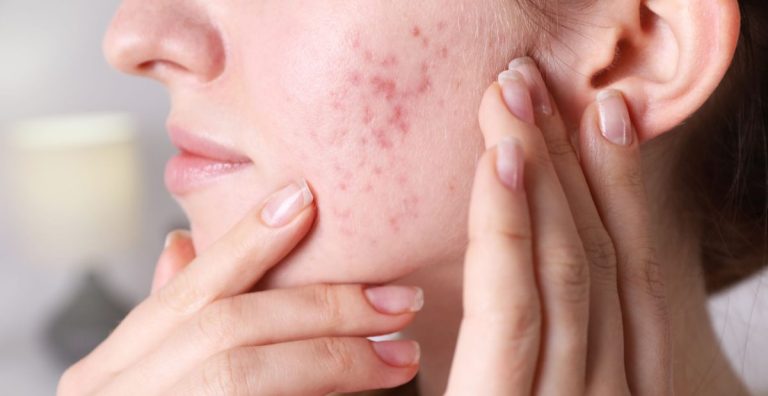 5 Cara Bagaimana Stres Memengaruhi Acne dan Cara Mengatasinya