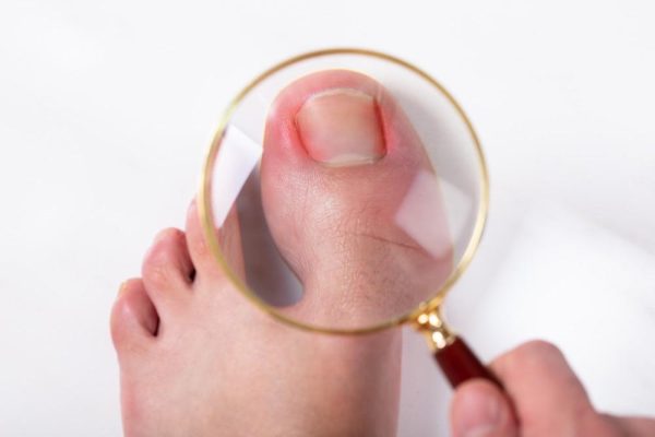 5 Cara Merawat Kuku Kaki Agar Tidak Tumbuh ke Dalam 5 Cara Merawat Kuku Kaki Agar Tidak Tumbuh ke Dalam