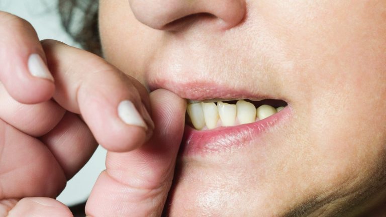 5 Kebiasaan Buruk yang Bisa Merusak Kesehatan Bibir