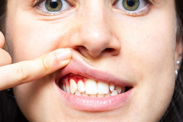 7 Tips Menghindari Gusi Berdarah saat Puasa 7 Tips Menghindari Gusi Berdarah saat Puasa7 Tips Menghindari Gusi Berdarah saat Puasa7 Tips Menghindari Gusi Berdarah saat Puasa7 Tips Menghindari Gusi Berdarah saat Puasa7 Tips Menghindari Gusi Berdarah saat Puasa7 Tips Menghindari Gusi Berdarah saat Puasa7 Tips Menghindari Gusi Berdarah saat Puasa7 Tips Menghindari Gusi Berdarah saat Puasa7 Tips Menghindari Gusi Berdarah saat Puasa7 Tips Menghindari Gusi Berdarah saat Puasa7 Tips Menghindari Gusi Berdarah saat Puasa7 Tips Menghindari Gusi Berdarah saat Puasa7 Tips Menghindari Gusi Berdarah saat Puasa7 Tips Menghindari Gusi Berdarah saat Puasa7 Tips Menghindari Gusi Berdarah saat Puasa