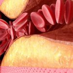 7 Cara Alami Membersihkan Pembuluh Darah dari Plak