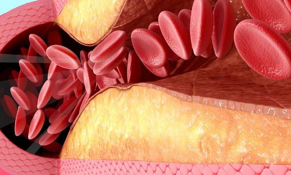 7 Cara Alami Membersihkan Pembuluh Darah dari Plak