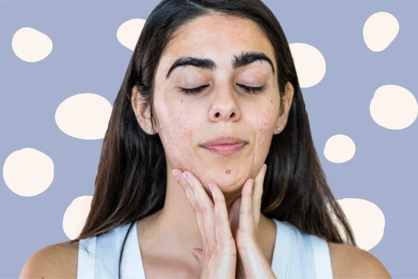 7 Tips Menghindari Komedo di Area Dagu 7 Tips Menghindari Komedo di Area Dagu