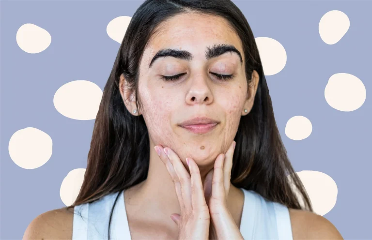 7 Tips Menghindari Komedo di Area Dagu