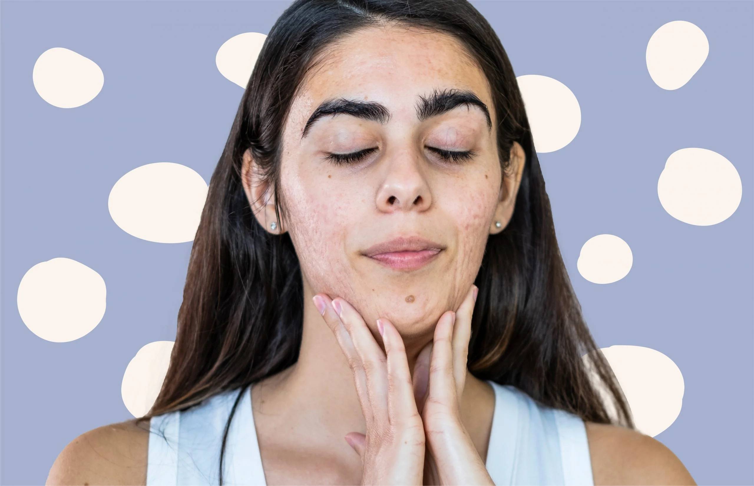 7 Tips Menghindari Komedo di Area Dagu