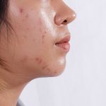 5 Cara Mengurangi Minyak Berlebih Penyebab Jerawat