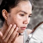 5 Cara Mencegah Flek Hitam Muncul di Dagu